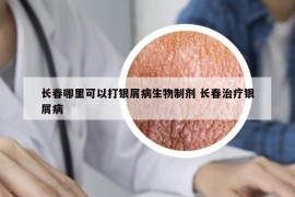 长春哪里可以打银屑病生物制剂 长春治疗银屑病