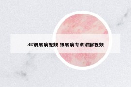 3D银屑病视频 银屑病专家讲解视频