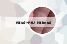 掌跖治疗中药配方 掌跖怎么治疗