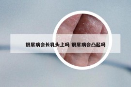 银屑病会长乳头上吗 银屑病会凸起吗