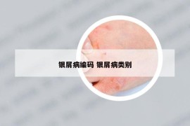 银屑病编码 银屑病类别