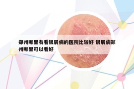 郑州哪里有看银屑病的医院比较好 银屑病郑州哪里可以看好