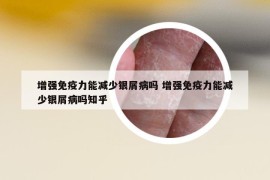 增强免疫力能减少银屑病吗 增强免疫力能减少银屑病吗知乎