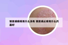 银屑病痒痒用什么消毒 银屑病止痒用什么药最好