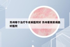 苏州哪个治疗牛皮癣医院好 苏州看银屑病最好医院