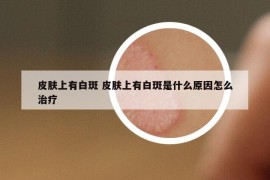 皮肤上有白斑 皮肤上有白斑是什么原因怎么治疗