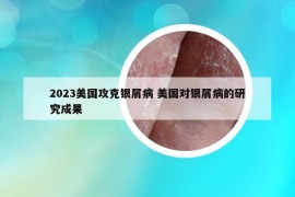 2023美国攻克银屑病 美国对银屑病的研究成果