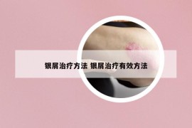 银屑治疗方法 银屑治疗有效方法