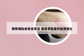 银屑病给血有关系没 银屑病患者的血液变化