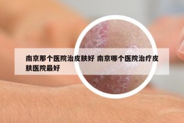 南京那个医院治皮肤好 南京哪个医院治疗皮肤医院最好