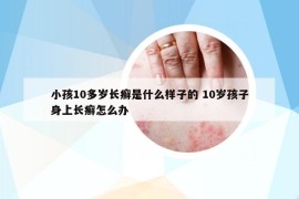 小孩10多岁长癣是什么样子的 10岁孩子身上长癣怎么办