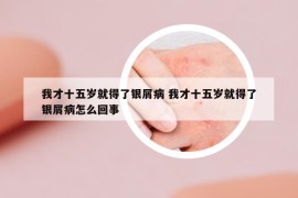 我才十五岁就得了银屑病 我才十五岁就得了银屑病怎么回事