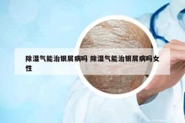 除湿气能治银屑病吗 除湿气能治银屑病吗女性