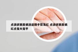 点滴状银屑病消退期手臂发红 点滴状银屑病红点变大变平