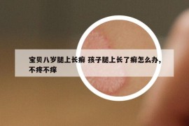 宝贝八岁腿上长癣 孩子腿上长了癣怎么办,不疼不痒