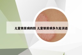 儿童银屑病四肢 儿童银屑病多久能消退