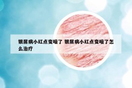 银屑病小红点变暗了 银屑病小红点变暗了怎么治疗