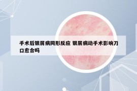 手术后银屑病同形反应 银屑病动手术影响刀口愈合吗