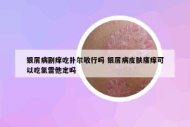 银屑病剧痒吃扑尔敏行吗 银屑病皮肤瘙痒可以吃氯雷他定吗