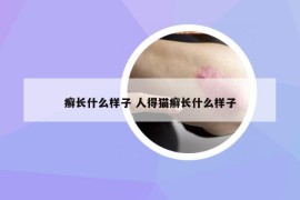 癣长什么样子 人得猫癣长什么样子