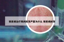 银屑病治疗期间脱发严重为什么 银屑病掉发