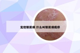 龙炮银屑病 什么叫银屑病疱疹