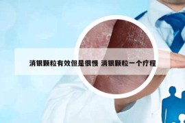 消银颗粒有效但是很慢 消银颗粒一个疗程