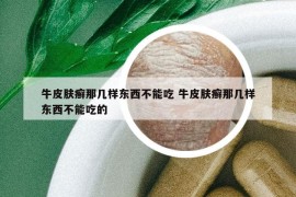 牛皮肤癣那几样东西不能吃 牛皮肤癣那几样东西不能吃的