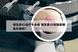 维生素d3治疗牛皮癣 维生素d3对银屑病有作用吗?