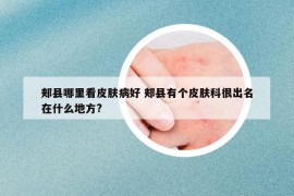 郏县哪里看皮肤病好 郏县有个皮肤科很出名在什么地方?