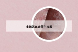 小孩怎么会得牛皮廨