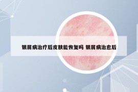 银屑病治疗后皮肤能恢复吗 银屑病治愈后