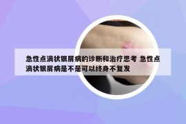 急性点滴状银屑病的诊断和治疗思考 急性点滴状银屑病是不是可以终身不复发