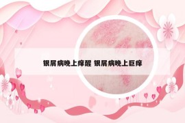 银屑病晚上痒醒 银屑病晚上巨痒