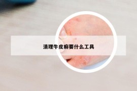 清理牛皮癣要什么工具