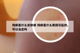 钱癣是什么皮肤病 钱癣是什么原因引起的,可以治愈吗