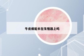 牛皮癣能长在生殖器上吗