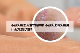 小孩头癣怎么治才能除根 小孩头上有头癣用什么方法比较好