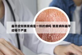 扁平疣和银屑病是一样的病吗 银屑病和扁平疣哪个严重