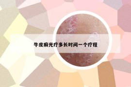 牛皮癣光疗多长时间一个疗程