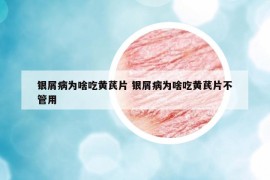 银屑病为啥吃黄芪片 银屑病为啥吃黄芪片不管用