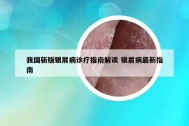 我国新版银屑病诊疗指南解读 银屑病最新指南