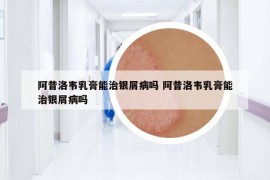 阿昔洛韦乳膏能治银屑病吗 阿昔洛韦乳膏能治银屑病吗