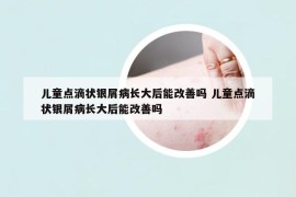 儿童点滴状银屑病长大后能改善吗 儿童点滴状银屑病长大后能改善吗