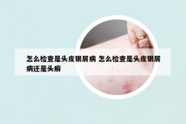 怎么检查是头皮银屑病 怎么检查是头皮银屑病还是头癣