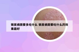 银屑病需要多吃什么 银屑病需要吃什么药效果最好