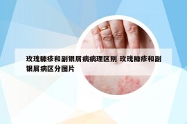 玫瑰糠疹和副银屑病病理区别 玫瑰糠疹和副银屑病区分图片