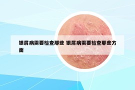 银屑病需要检查那些 银屑病需要检查那些方面