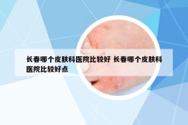 长春哪个皮肤科医院比较好 长春哪个皮肤科医院比较好点