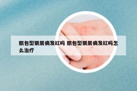 脓包型银屑病发红吗 脓包型银屑病发红吗怎么治疗